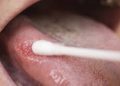 WHO Backs Tongue Swabs to End TB