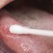WHO Backs Tongue Swabs to End TB