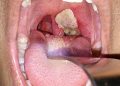 Diphtheria Outbreak Threatens Northern Nigeria’s Schoolchildren