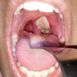 Diphtheria Outbreak Threatens Northern Nigeria’s Schoolchildren